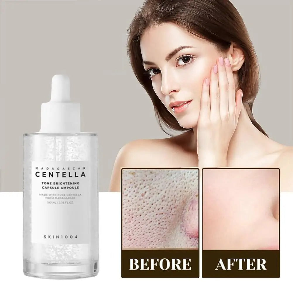 Original Centella Acne remover